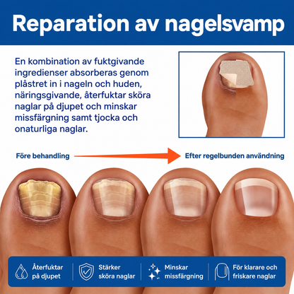 NagelFrisk™ Enkel & diskret behandling mot nagelsvamp