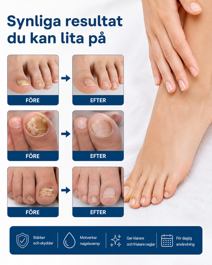 NagelFrisk™ Enkel & diskret behandling mot nagelsvamp